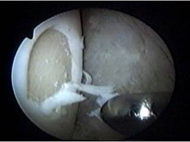 Artroscopia